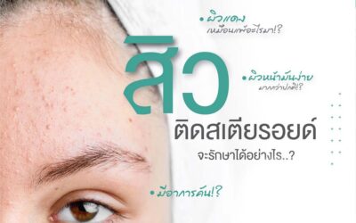 สิวสเตียรอยด์ จุดเริ่มต้นของปัญหาสิวเรื้อรัง