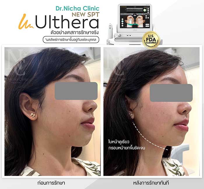 ผลการทำ Ulthera กรอบหน้า