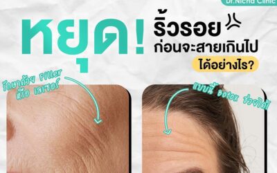 ริ้วรอยก่อนวัย 2 ประเภท คุณเป็นแบบไหน?