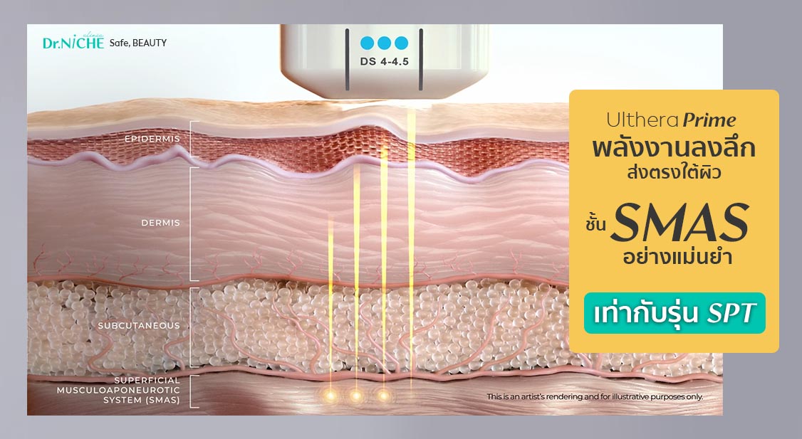 Ulthera Prime ส่งพลังงานลงลึกถึงผิวชั้น SMAS เท่ากับรุ่น SPT