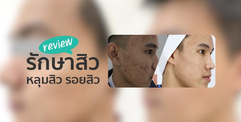 รีวิวการรักษาสิว หลุมสิว รอยสิว