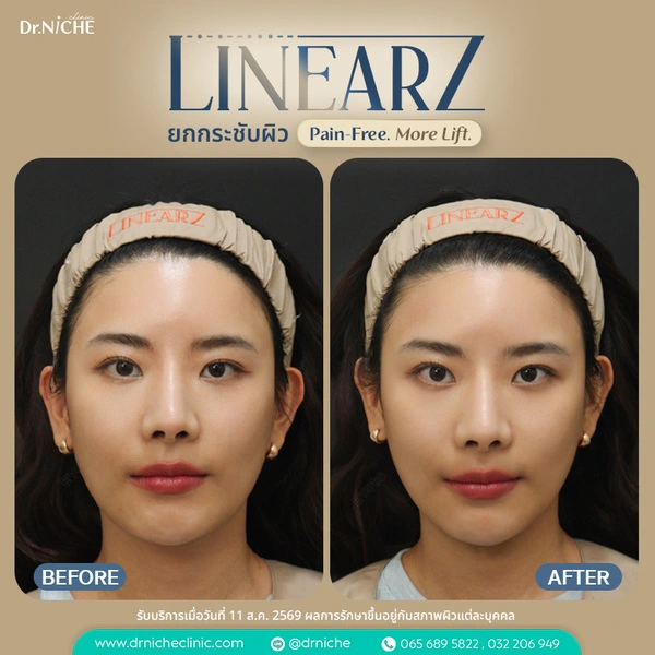 ผลหลังทำ Linear Z