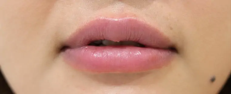 After · แก้ปากบาง ตามช่วงวัย