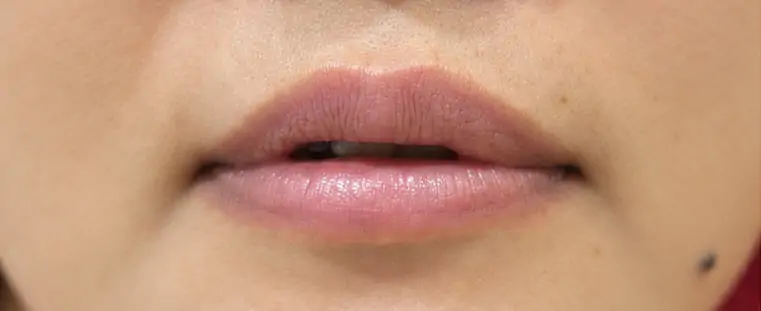 Before · แก้ปากบาง ตามช่วงวัย