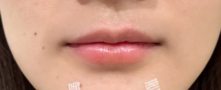 After · แก้ปัญหาเนื้อปากน้อย