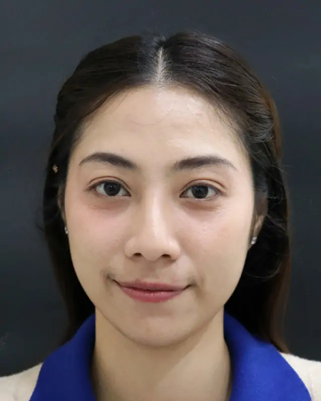 Before · ฟิลเลอร์ปาก ร่วมกับปรับรูปหน้า