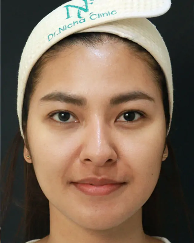 Before · ฟิลเลอร์ปาก ร่วมกับปรับรูปหน้า