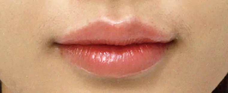 After · ทรงธรรมชาติ
