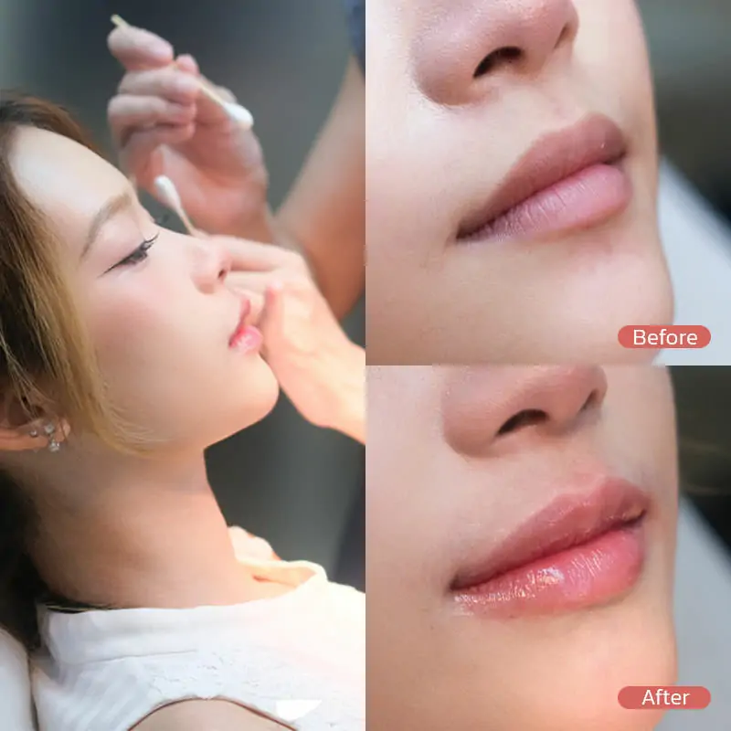 Lips Filler Case ฟิลเลอร์ปาก restylane kysse