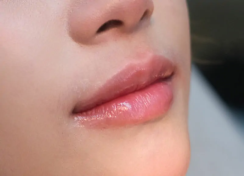 ภาพปากระยะใกล้มุมตรงของเคสเดียวกัน